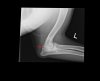 X-ray Left Elbow 042313.jpg