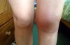 Swollen knee.jpg